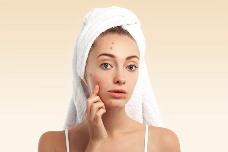 closeup-young-woman-with-towel-head-pimples-face_273609-14430
